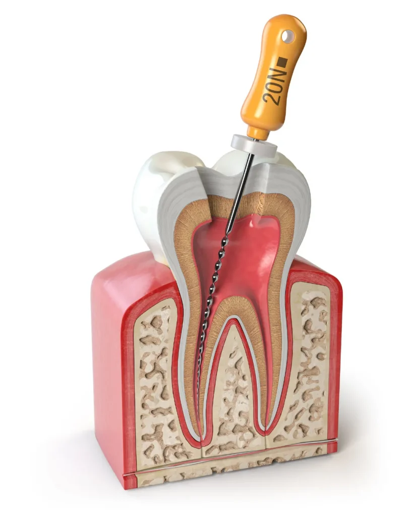 รักษารากฟัน